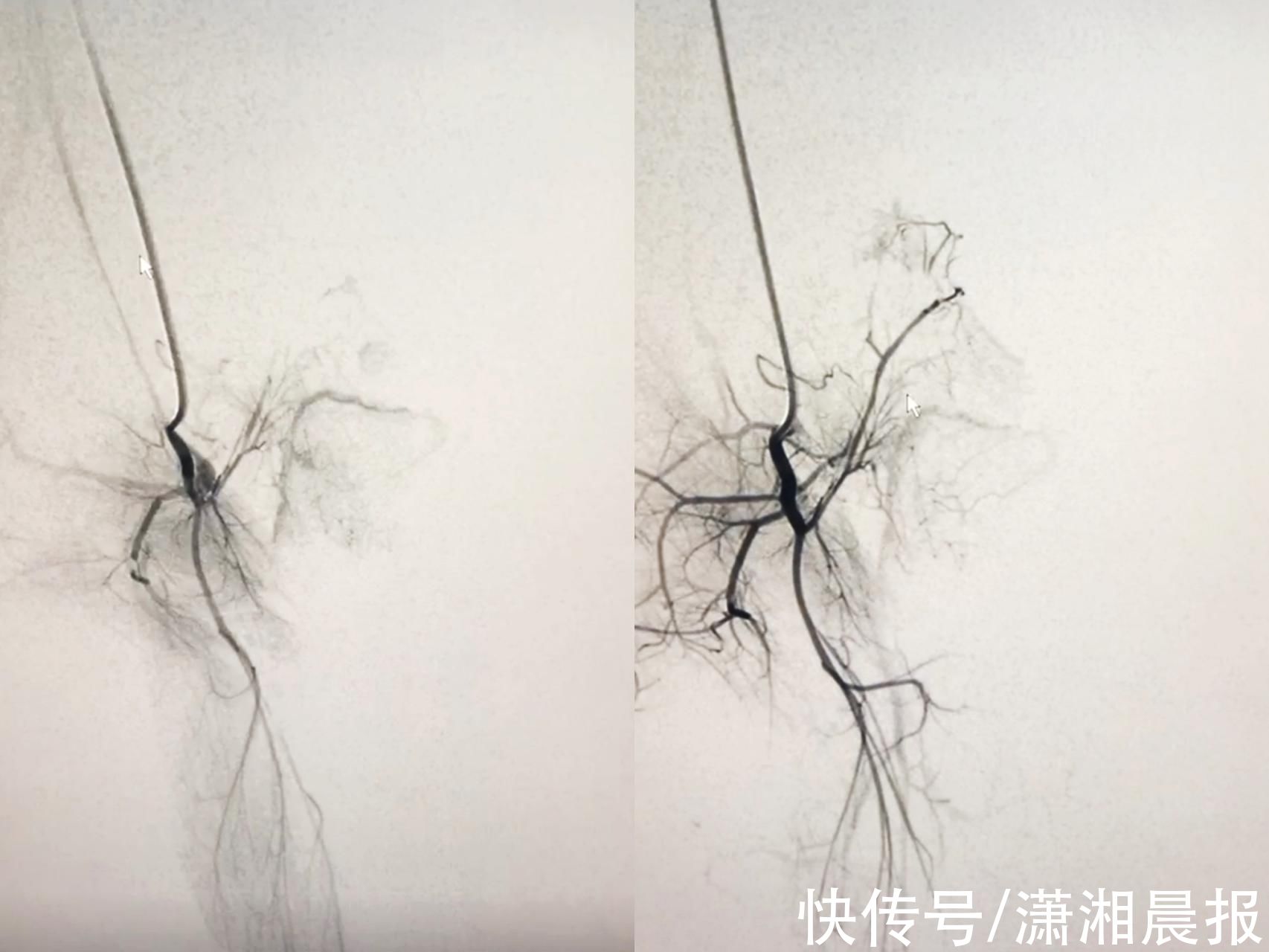 湖南省|湖南省儿童医院血管介入科开科