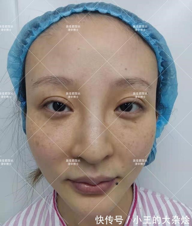 面部 做过3次线雕的她,为什么还要跑来做拉皮手术!