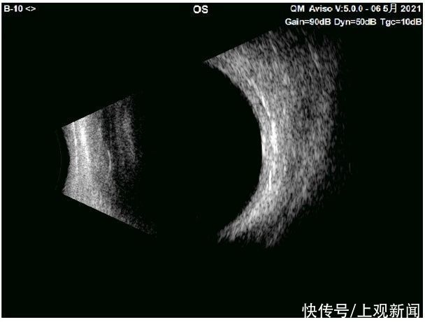 b超|眼外伤不可怕，重见光明有希望