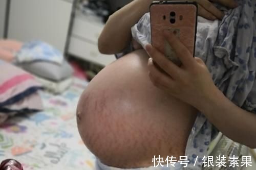 体重|“毁容式”怀孕之妊娠纹:10个孕妈9个长纹,教你咋应对咋预防