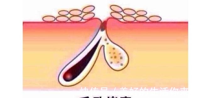 毛孔堵塞 脸上“毛孔堵塞”该怎么办护肤做好这几步,减少皮肤困扰!