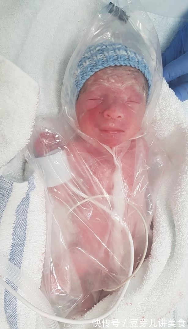 里菲特|早产3个月的龙凤胎迎来生日,为模仿妈妈的子宫曾被裹在食品袋里