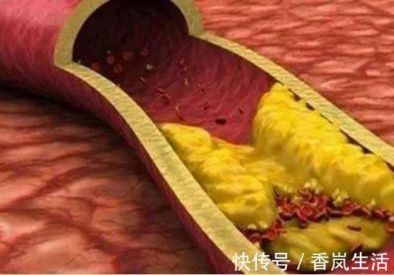 含量|高血脂的“祸根”找到了,不只是肥肉,多数人忽略了,当美食