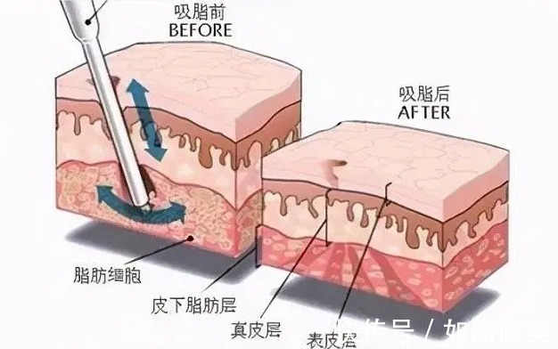 腹部 超脂塑腹部溶脂会有危害吗？属于微创手术吗？适用于哪些部位？