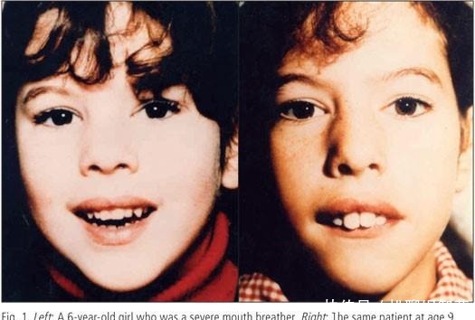 孩子|用嘴呼吸会变丑?父母看到宝宝用嘴呼吸要即使制止!