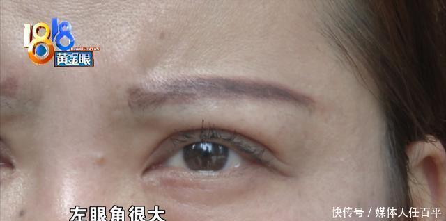 “童颜”做了两个项目，眼角过大额头坑洼