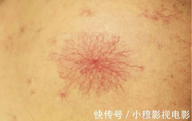 酒精肝|杭州一男子，养肝2个月，转氨酶从380降至38，他是怎么做的？