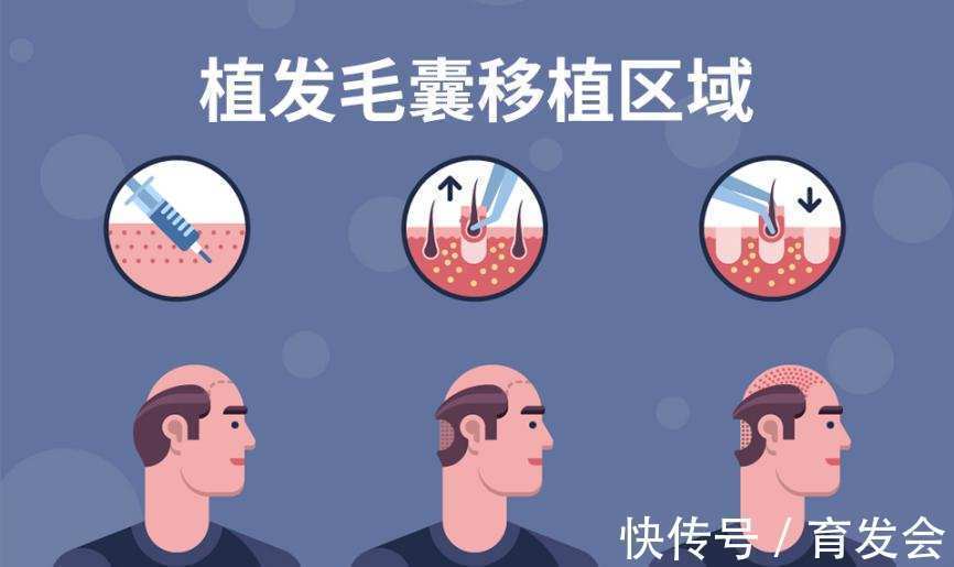 成活率 用植发生发,你要闯过这些难关,否则白费!