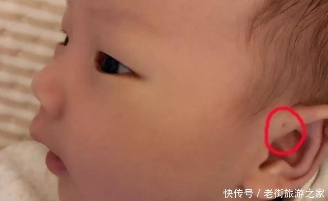 发炎|如果宝宝耳朵上有小孔,千万别乱碰,后果比你想象严重