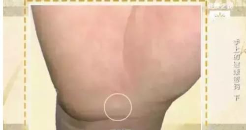 健康|觀手知健康！快速辨識高血壓、高血糖就這么看，2分鐘學會！