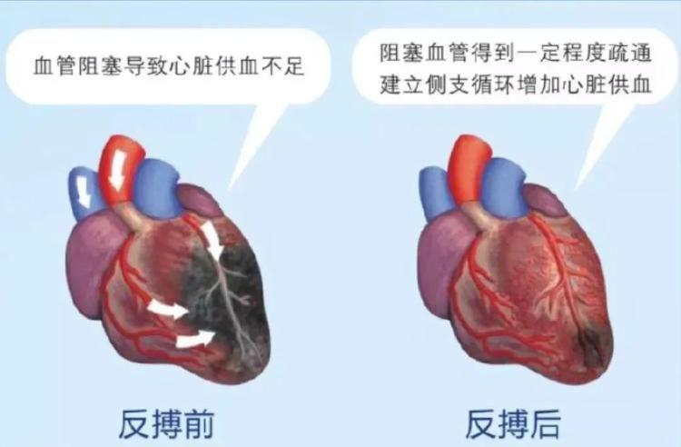 收缩期|潍坊市人民医院专家为您讲解什么是体外反搏？