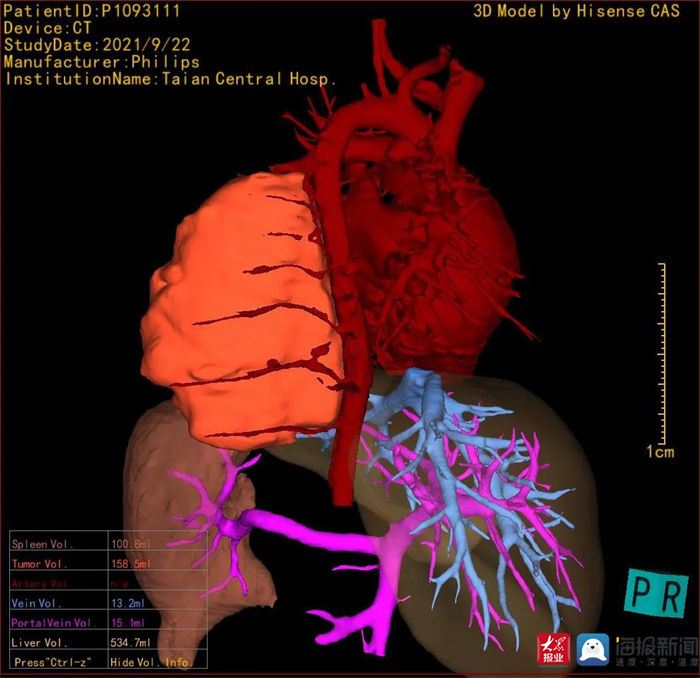 先天性|四岁男孩患肿瘤 泰安市中心医院儿外科新设备助力精准切除
