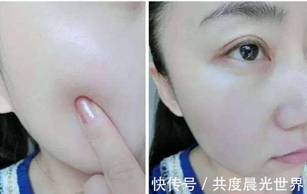 红霉素|红霉素加它敷脸,半个月不到,痘痘、痘印都没了,皮肤还变得嫩滑!
