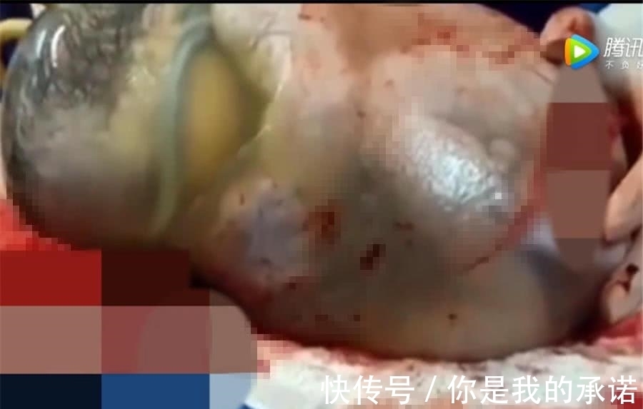 宝宝|婴儿出世羊膜完好无损,蜷缩身体再现子宫内情况,医生:概率极低