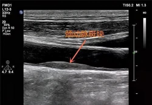 动脉|动脉硬化≠动脉粥样硬化，学好软化血管3个步骤，血流通畅少堵塞