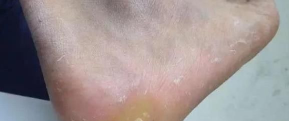 茧子|脚上长“茧子”和疾病有关？若脚上出现4种茧子，一定要留意了！