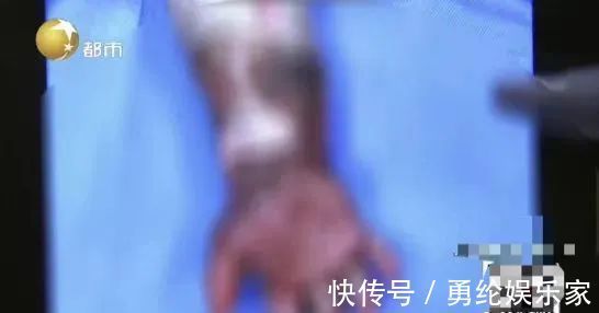 总医院|17个月大宝宝被严重烫伤!奶奶第一时间一个举动,雪上加霜