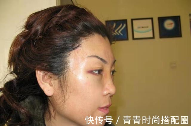 颞部 颞部切口小拉皮术后即刻,老公没找到切口在哪!