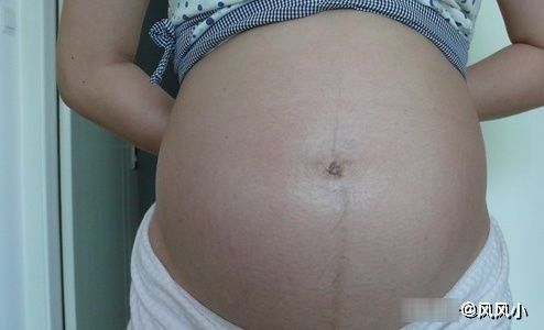 肚脐|为何有些孕妇肚脐是“凸出来”的？这些原因很重要，第一个别忽视