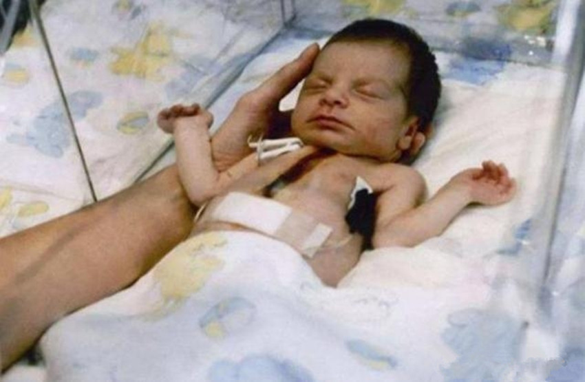 孩子|还记得36年前移植“狒狒”心脏的女婴吗手术虽成功，但结局惋惜
