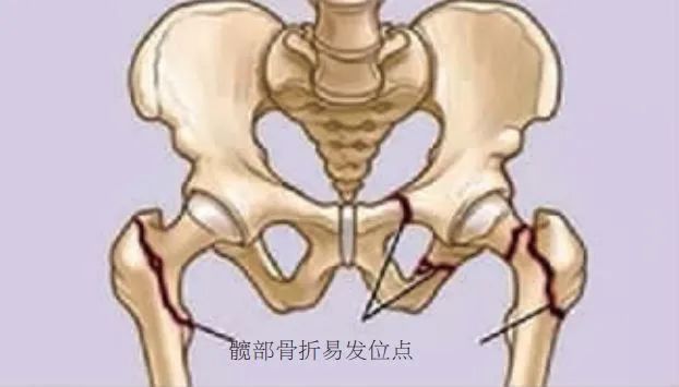 阿太|这种骨折，死亡率高达50%！保守治疗还是手术？95岁阿太亲身经历……