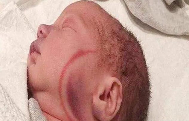 死亡|孕妇破水15小时,生产后娃“意外”死亡,家属孩子是被产钳夹死