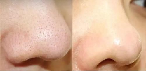 住手!这就是你长黑头的原因!