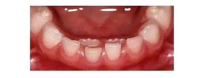 换牙|宝宝长出双排牙,是妈妈在作怪,孩子饮食出问题了!