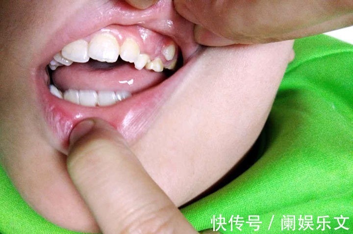 营养均衡|6岁孩子长出双排牙,医生询问原因后才得知:都是精细喂养惹的祸