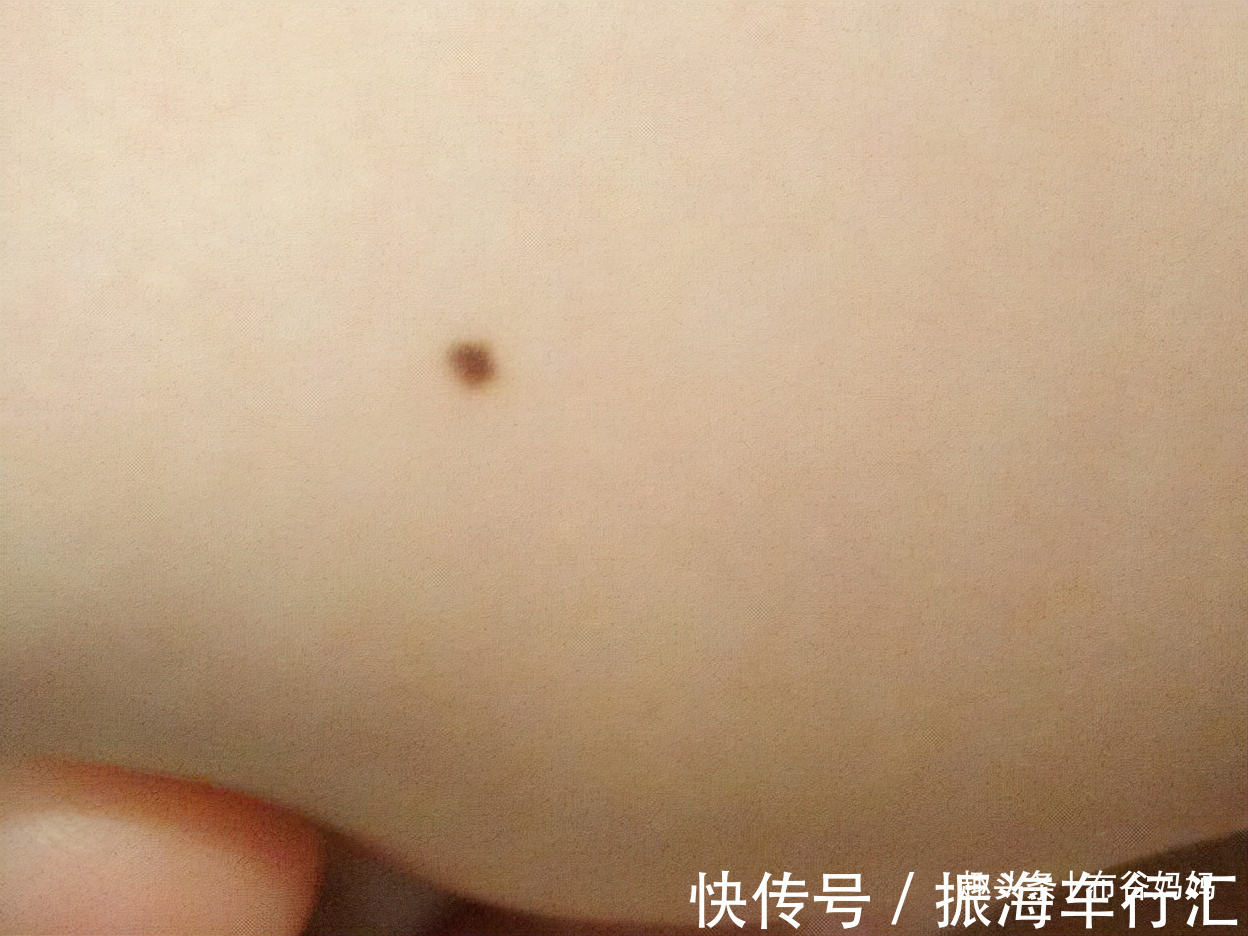 孕期|胎记是怎么来的?产科医生:孕期要避开3种行为,以免宝宝长胎记
