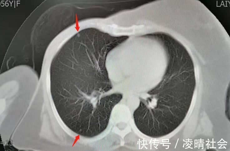 病人|对癌症病人隐瞒病情,是善意的谎言吗?对治疗有帮助吗?