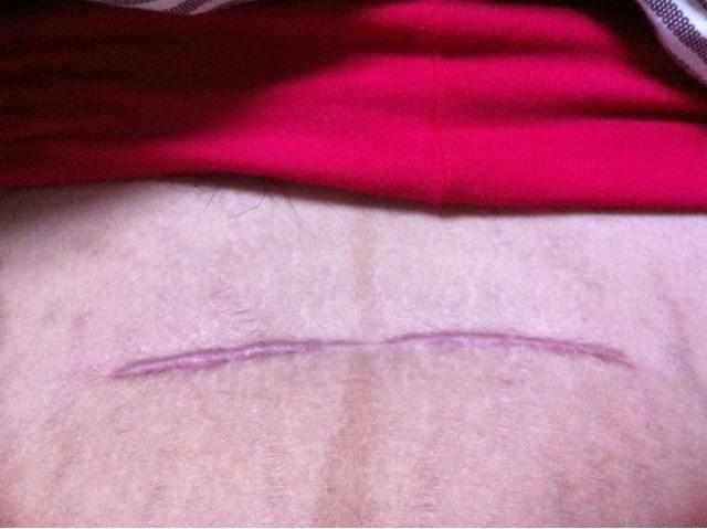 媛媛|女性剖腹产后通常有这四大“后遗症”,很煎熬,愿你一个都没有