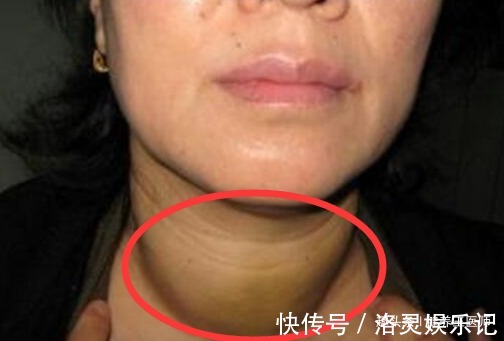 女性|女性有癌，脖子先知！脖子出现这种情况，建议你最好赶紧去检查！