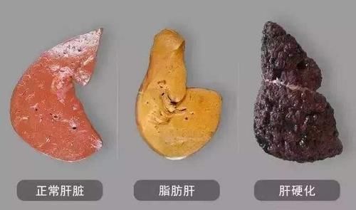 凝血因子|天然的“养肝王”找到了,不是枸杞和大蒜,你若爱吃,肝日益变好