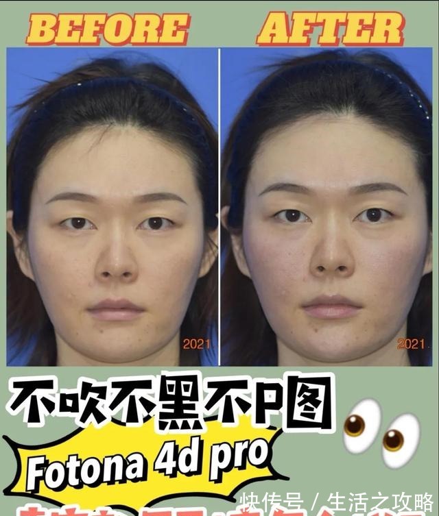 热玛吉 不吹不黑不P图,卡戴珊同款医美真实效果如何!