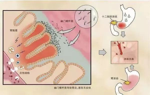 十二指肠|被列为明确致癌物！近60%国人已感染！如何才能避免？