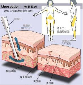 超声吸脂术真的安全吗？腰腹吸脂有效果吗？