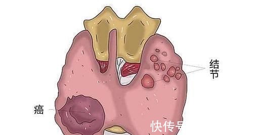 手术|为何有些癌症患者,手术后还是会复发是治疗的不彻底吗