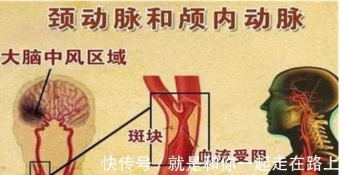 颈动脉|颈动脉有斑块,会有哪些症状?应该如何治疗?医生告诉你答案