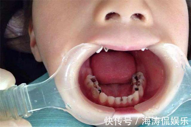 女儿|家里这3种东西,比糖更易让孩子长出“黑牙”,家长应该了解