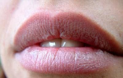 嘴唇总是干裂没亮泽？不只是缺水，还跟缺乏一种营养素有关