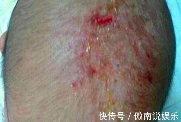医生|3个月宝宝半夜高烧不退,医生检查完孩子头部,气的当场发飙!