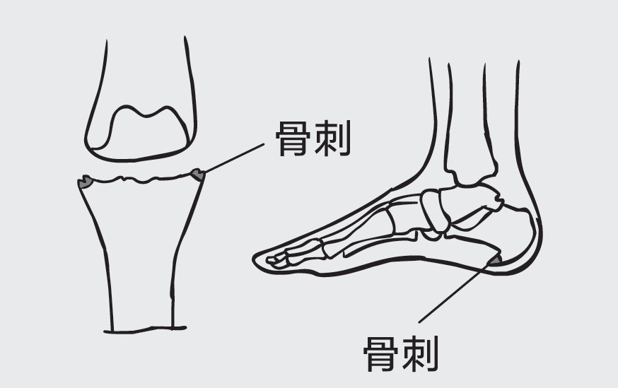 关节|如何才能把骨刺消掉？