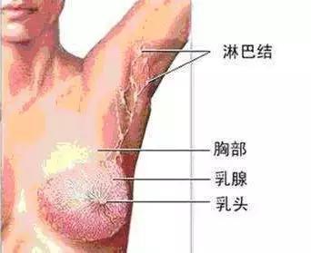 淋巴结|小心！耳朵后面长个小疙瘩不痛也不痒，上医院一查竟是肺癌