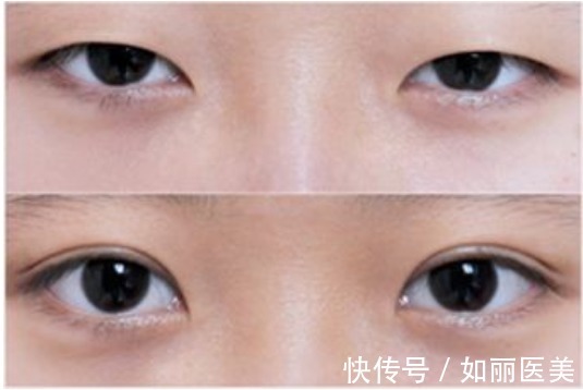 纱布 割双眼皮的注意事项有哪些?做好这些注意事项,术后效果倍棒!