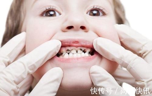 龋齿|不想孩子一口烂牙，这些坑可要避开了，家长多上心
