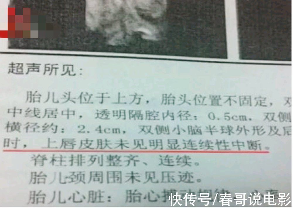 叶酸|为何在孕期正常吃叶酸,胎儿还会“唇腭裂”?孕妈别耍小聪明了