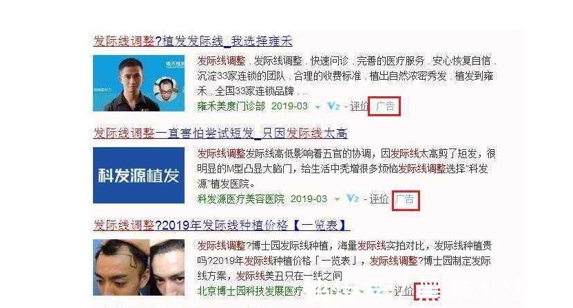 效果好 黑米3D纹发:关于植发的一些事实《9-11》