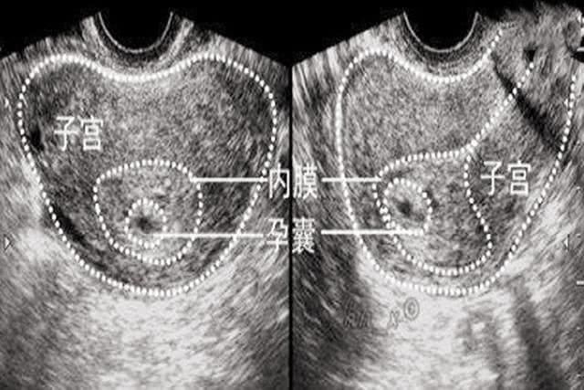 孕期第一次产检中，这三个指标合格，恭喜你，说明胎儿发育健康