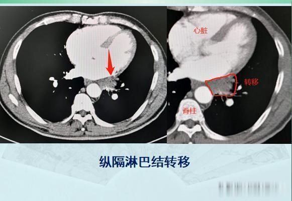 原发灶|两个肺癌病人都拖了2年才治疗，一个治愈，一个扩散了